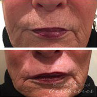 Facial Fillers Before & After Photo