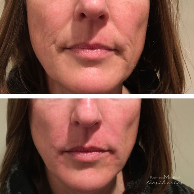 Facial Fillers Before & After Photo