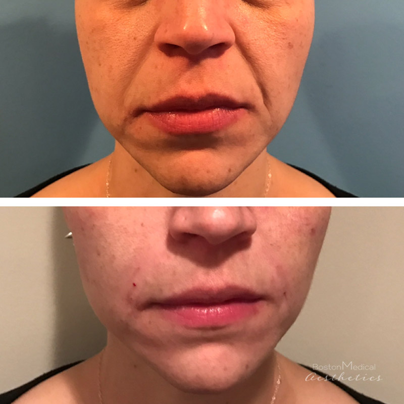 Facial Fillers Before & After Photo