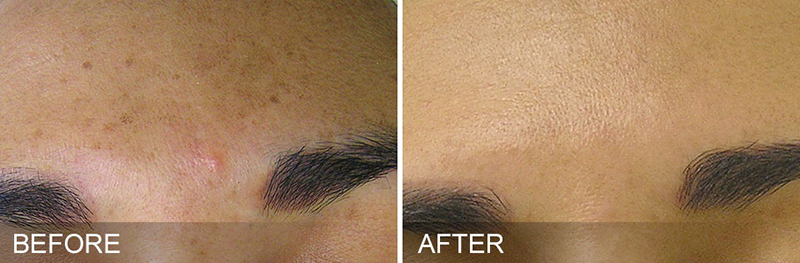 Hydrafacial Before & After Photo