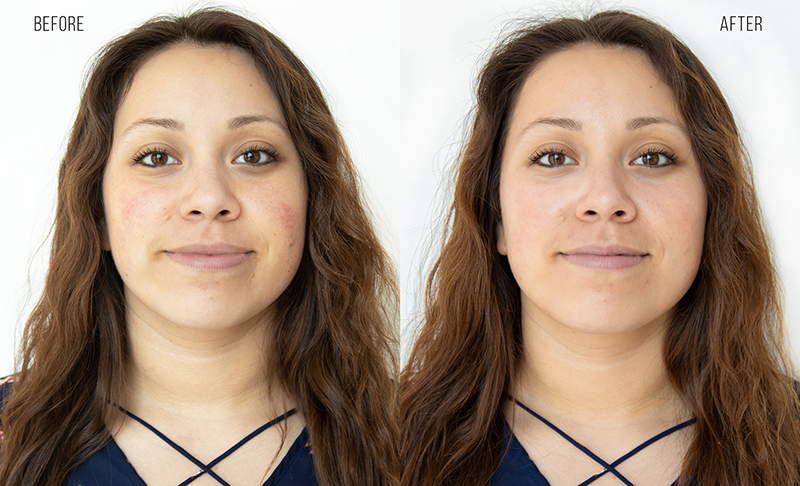 Hydrafacial Before & After Photo