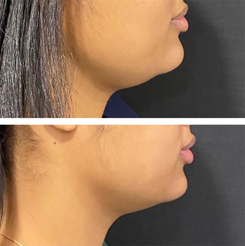 Kybella Before & After Photo