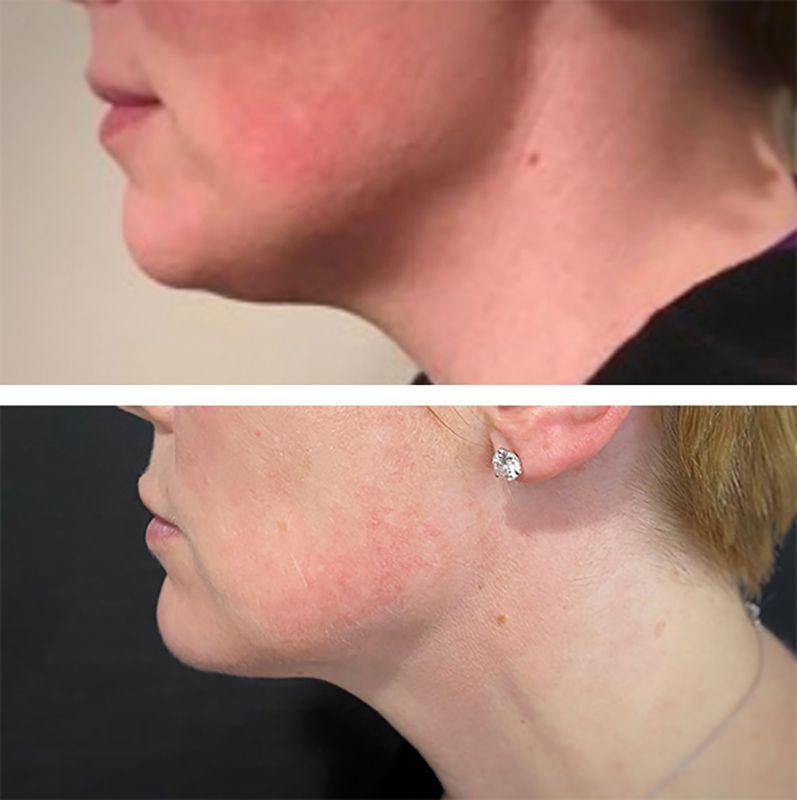 Kybella Before & After Photo