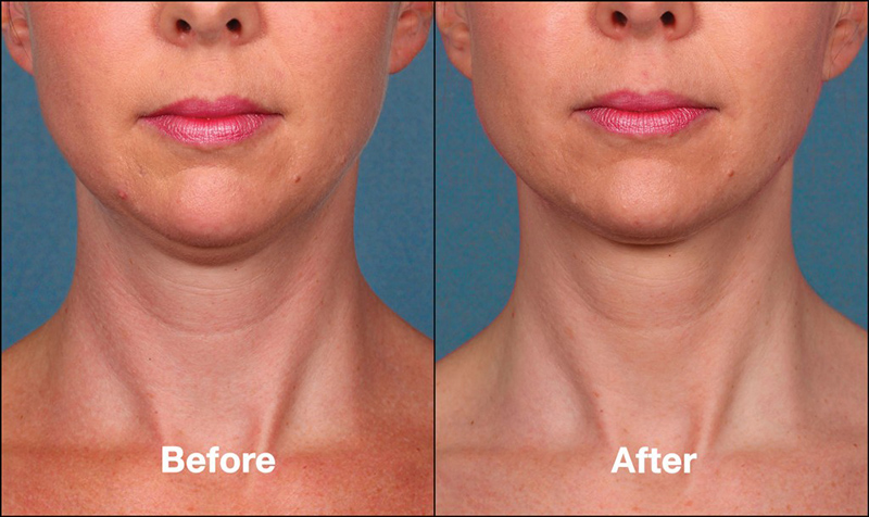 Kybella Before & After Photo