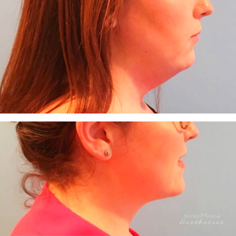 Kybella Before & After Photo