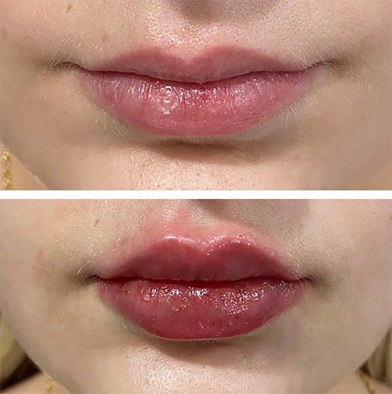 Lip Fillers Before & After Photo