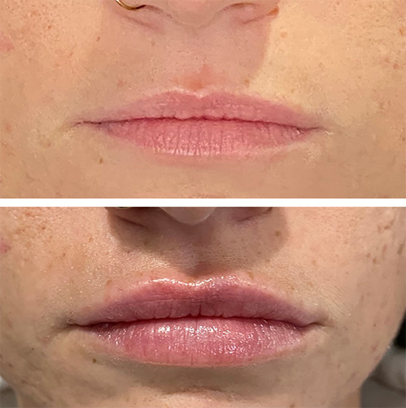 Lip Fillers Before & After Photo