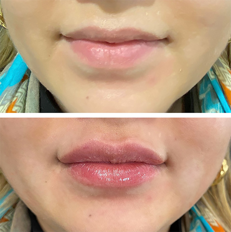 Lip Fillers Before & After Photo