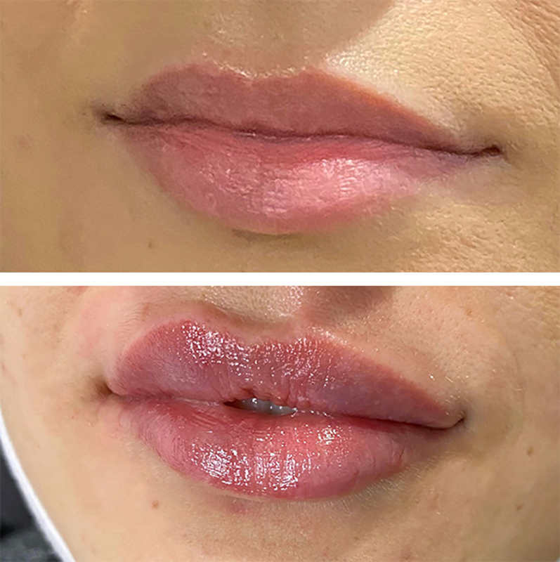 Lip Fillers Before & After Photo