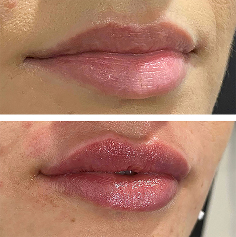 Lip Fillers Before & After Photo