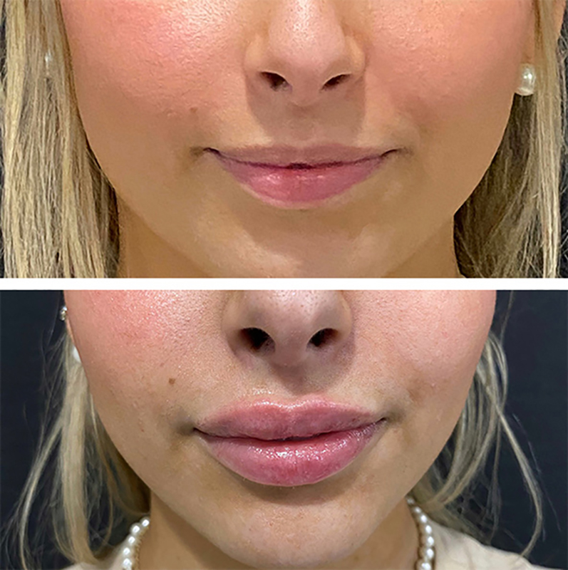 Lip Fillers Before & After Photo