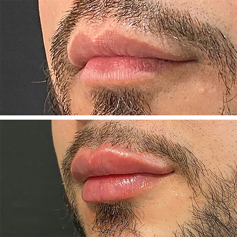 Lip Fillers Before & After Photo