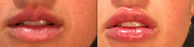 Lip Fillers Before & After Photo