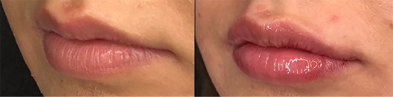 Lip Fillers Before & After Photo