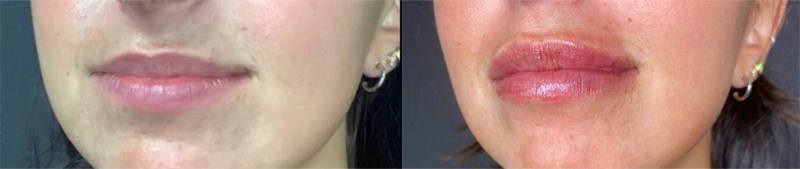 Lip Fillers Before & After Photo