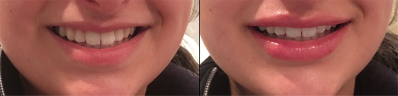 Lip Fillers Before & After Photo