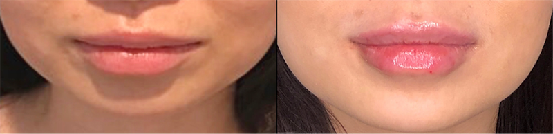 Lip Fillers Before & After Photo