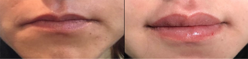 Lip Fillers Before & After Photo