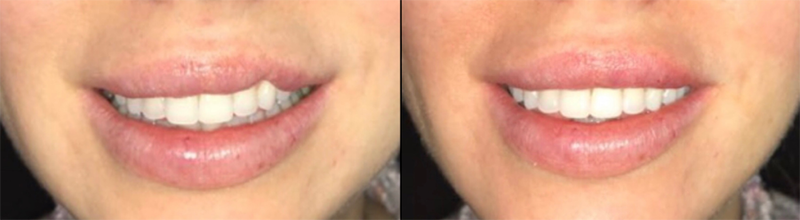 Lip Fillers Before & After Photo