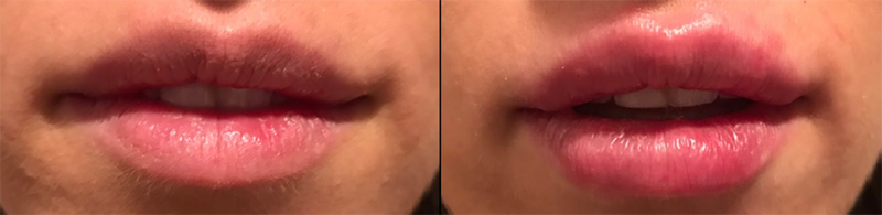 Lip Fillers Before & After Photo