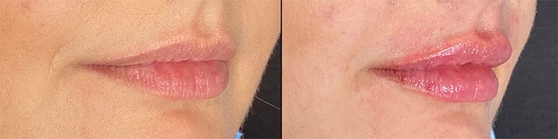 Lip Fillers Before & After Photo