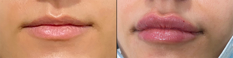 Lip Fillers Before & After Photo