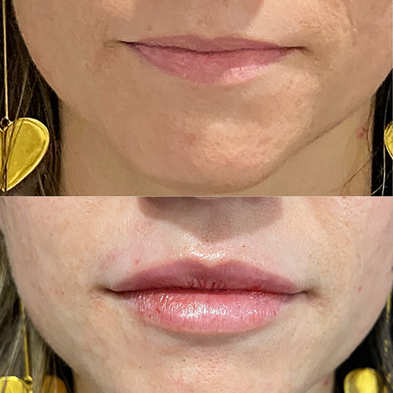 Lip Fillers Before & After Photo