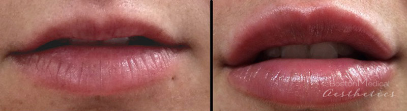 Lip Fillers Before & After Photo