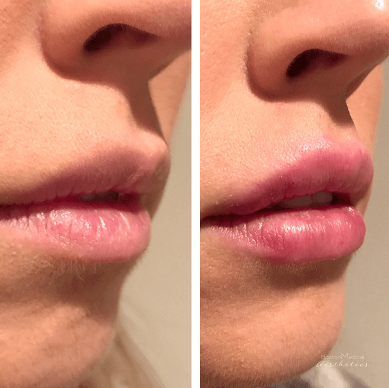 Lip Fillers Before & After Photo