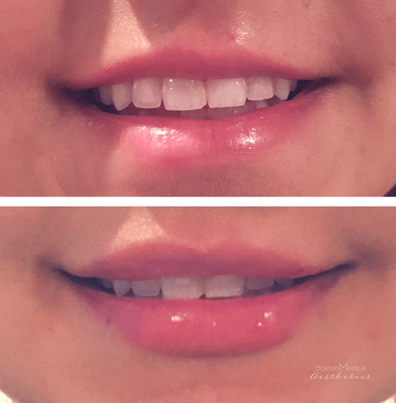 Lip Fillers Before & After Photo