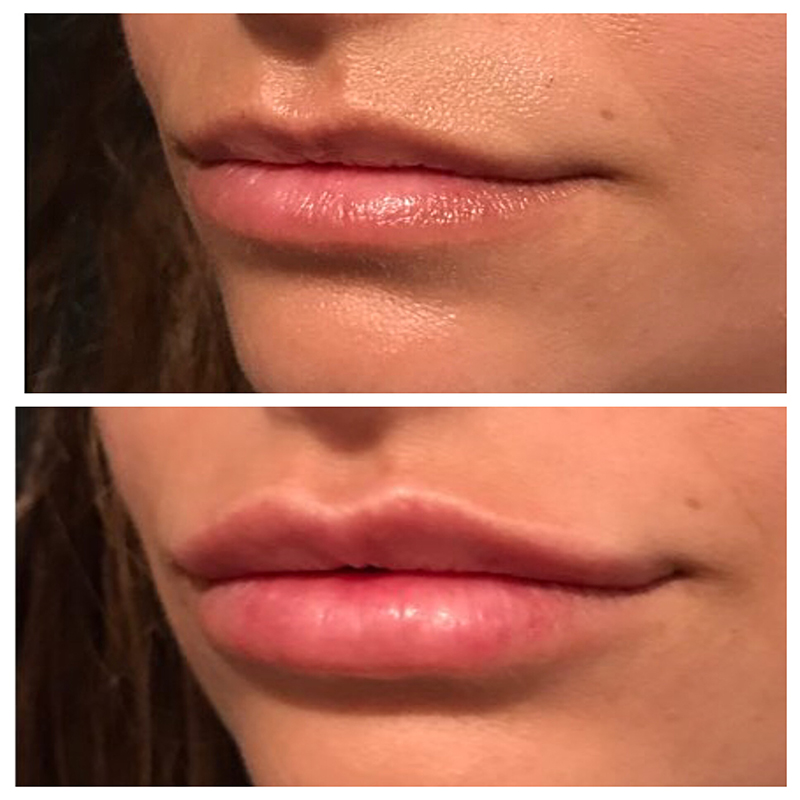 Lip Fillers Before & After Photo