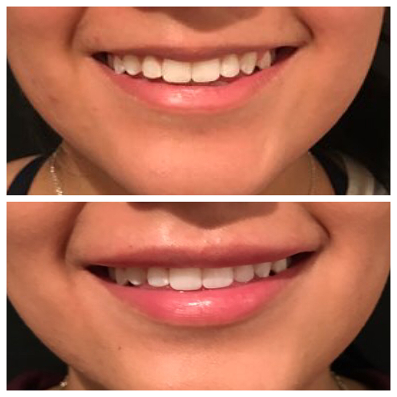 Lip Fillers Before & After Photo