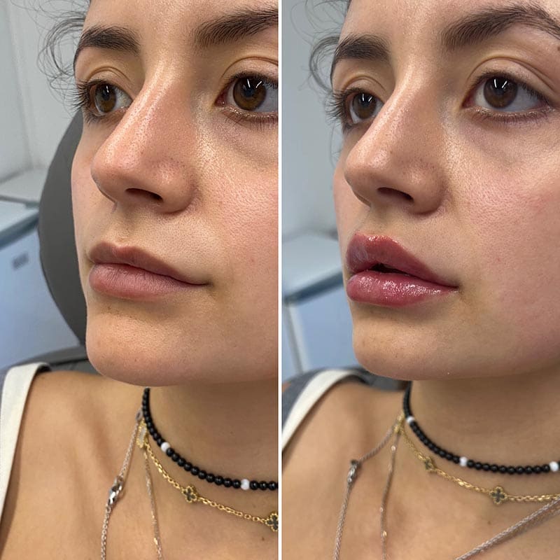 Lip Fillers Before & After Photo