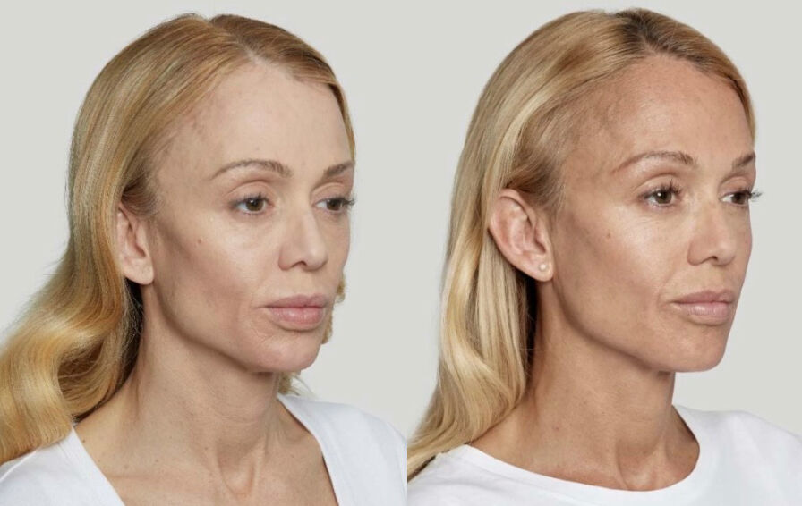 Sculptra Before & After Photo