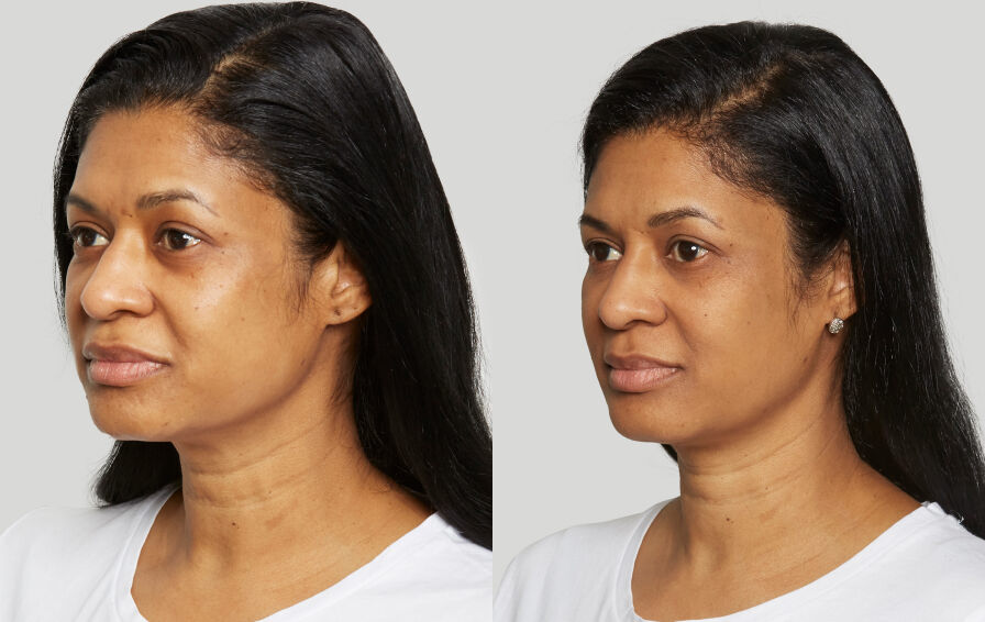 Sculptra Before & After Photo