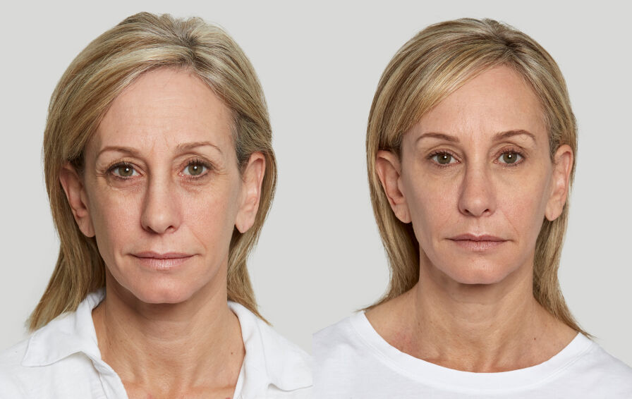 Sculptra Before & After Photo